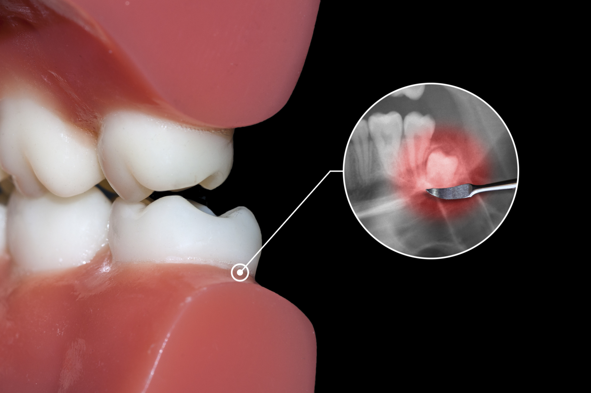 How Much Is Wisdom Tooth Removal Adelaidesleephealth au